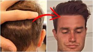 How do I get my Hair Cut after an FUT Hair Transplant?!