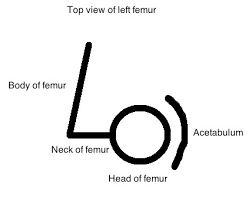 Image result for Femoral Retroversion