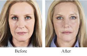 Use at the site of skin sores, … Sculptra Aesthetic Not Available Innovative Aesthetics