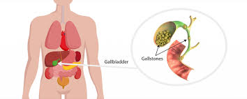 Image result for Gallstone
