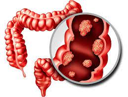 Potent, yet safe — you & your loved one can beat cancer too — learn more here! Symptoms Of Bowel Cancer Booking Health