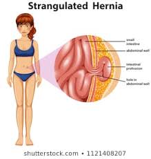 Hernia Images Stock Photos Vectors Shutterstock