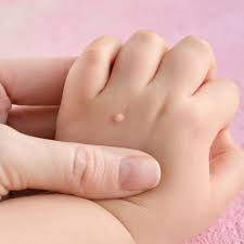 Ketuat plantar, secara perubatan dikenali sebagai verruca plantaris, adalah pertumbuhan kecil dan bukan barah di bahagian bawah kaki. Penyebab Dan Cara Atasi Kutil Di Tubuh Anak