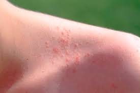 Image result for sweat rash on back