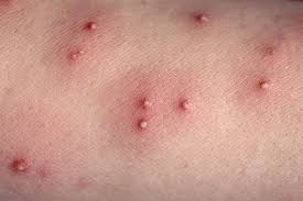 Image result for scabies bite
