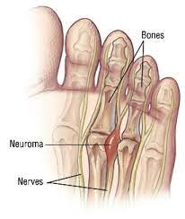 Morton S Neuroma The Right Shoes To Ease The Pain