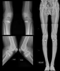 Image result for Genu Varum