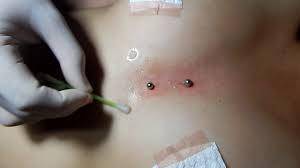 Colocando Un Piercing Surface Vertical En Pecho Sin Dolor Youtube
