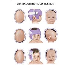 Image result for Positional Head Deformity