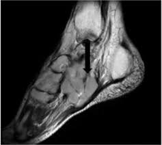 It arises from the base of the fifth metatarsal bone, and from the sheath of the fibularis longus. Ct And Mri Findings Of Soft Tissue Adult Fibrosarcoma In Extremities