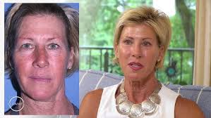 Dr. David Wages of North Shore Plastic Surgery & Med Spa demonstrates a  mini face lift procedure