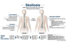 Fraktur atau patah tulang dapat terjadi pada salah satu vertebra di punggung tengah sebagai akibat dari cedera olahraga, kecelakaan mobil, atau jatuh. Cegah Skoliosis Bertambah Parah