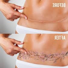 Nov 6 2019 explore kathyhergert s board tummy scar cover up followed by 184 people on pinterest. Pin On Tats