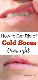 How To Get Rid Of Cold Sores Overnight 11 Best Home Remedies Cold Sore Which Is Also Called Fever Bliste Cold Sores Remedies Cold Sore Natural Cough Remedies