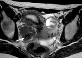 Here's what to know about endometriosis stages. Mr Imaging Of Endometriosis Spectrum Of Disease Sciencedirect