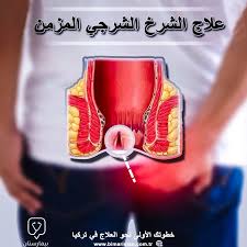 علاج الشرخ الشرجي المزمن (الشق الشرجي) في تركيا - بيمارستان