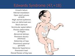 Reye's syndrome, acute hepatic encephalopathy, salicylic acid derivatives, children. Edwards Syndrome Imad Fadl Elmula Ppt Video Online Download