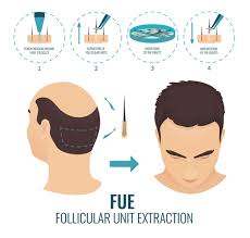 How much hair do you need? How Costly Is Hair Transplant Quora