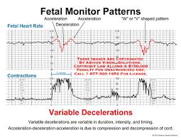 Amicus Illustration Of Amicus Chart Fetal Monitor Heart Rate