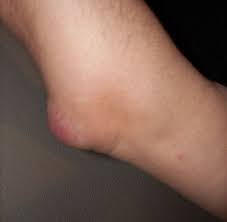 Bien que localisée au genou, la gonalgie peut aussi relever d'une autre faiblesse tant au niveau des hanches, de la colonne vertébrale que de la voûte plantaire. Hygroma Wikipedia