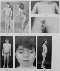 Juvenile dermatomyositis forty years on: Case report