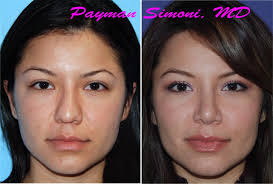 Rhinoplasty Side Effects Rhinoplasty Mini Face Lift Plastic Surgery
