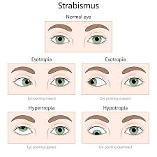 Image result for Strabismus
