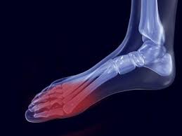 Pin By Susan Healy Kribs On 1 Foot Forward Foot Surgery Foot Surgery Recovery Ankle Surgery Recovery
