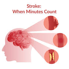 Symptoms of a massive stroke a stroke is a fatal condition that occurs when the artery to the brain gets blocked or when it. First Aid For Stroke Elite Medical Center