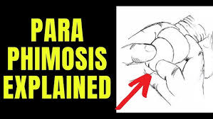 Image result for paraphimosis