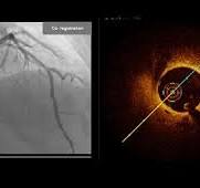 OCT Imaging Catheter: LumenCross F2 | Manufacturer ...