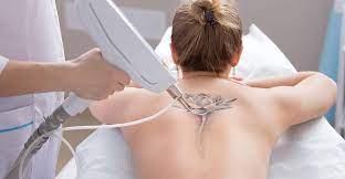 Suche schneller, besser & schlauer bei zapmeta! Laser Tattoo Removal Pensacola Tattoo Removal Pensacola