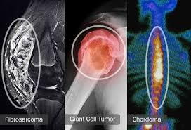 Pain is the most common sign of bone cancer, and may become more noticeable as the tumor grows. Visual Guide To Bone Cancer