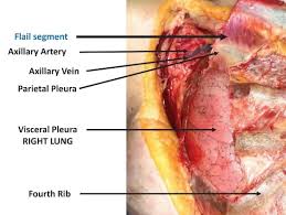 Image result for Flail Chest