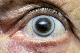 Does Arcus Senilis Mean High Cholesterol The Eye News