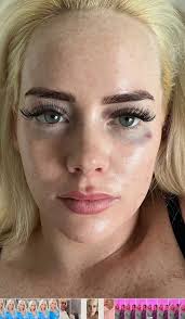 Report: Kathryn Dennis Seen With Facial Injuries