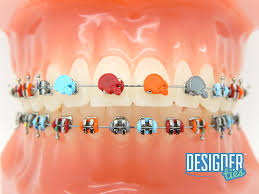 Traditional metal braces only come in one color: G H Orthodontics