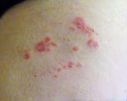 Image result for bedbugs bites