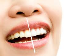 How to Whiten Sensitive Teeth Safely and Comfortably