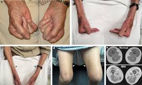 Inflammatory myositis dermatomyositis polymyositis antisynthetase syn. Inclusion Body Myositis Clinical Features And Pathogenesis Nature Reviews Rheumatology