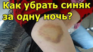как быстро убрать синяк на лице в домашних условиях Kak Ubrat Sinyak Za Odnu Noch Youtube