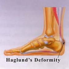 Insertional achilles tendinitis and haglund's deformity. Podiatrist In El Monte Haglund S Deformity In El Monte Payman Hoshyarsar