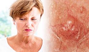 28.05.2020 · what is the life expectancy for basal cell skin cancer? Skin Cancer What Is The Survival Rate For This Type Of Cancer Express Co Uk