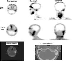 Image result for Necrotizing Otitis Externa