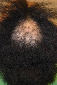 Hair growth serum, hair loss and hair thinning treatment, stops hair loss, natural herbal essence,thinning, balding, repairs hair follicles, promotes thicker, stronger hair and new hair growth (50ml) 1.69 fl oz (pack of 1) 3.5 out of 5 stars. African American Hair Loss Causes Dr Rogers New Orleans La