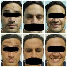 PDF) Ramsay Hunt Syndrome: Viral Infection Coexisting with COVID-19