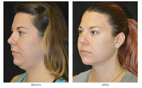 Double Chin Reduction in Boston, MA