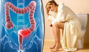 Rectal and colon cancer are rare before age 40. colon cancer symptoms may include persistent bleeding, a change in bowel habits or bowel movement shape, lower abdominal. Bowel Cancer Symptoms Signs Of Disease Similar To Piles Express Co Uk