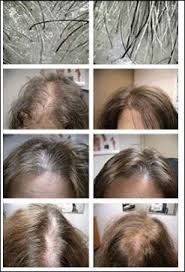 Once We Do A Microscopic Scalp Analysis We Will Be Able To Help Find A Solution To Move You In The Right Dir Hair Loss Remedies Hair Restoration Stop Hair Loss