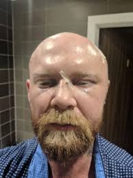 He punched me while my head was